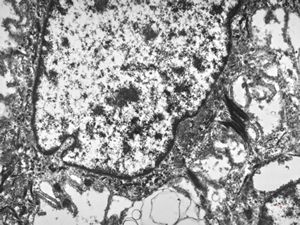 F,31y. | mucoepidermoid carcinoma